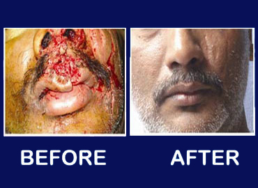 Before and after treatment from Isaac Ortho Hospital