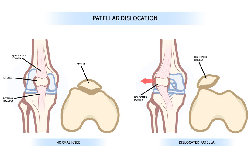 Habitual-Dislocation-of-Patella