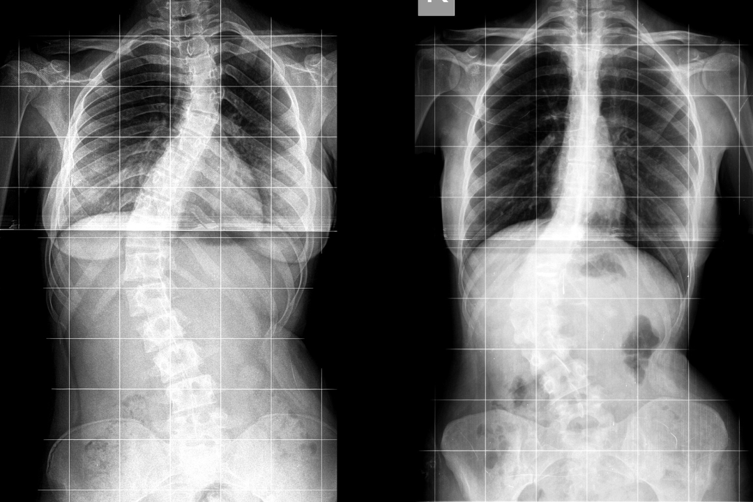 Scoliosis