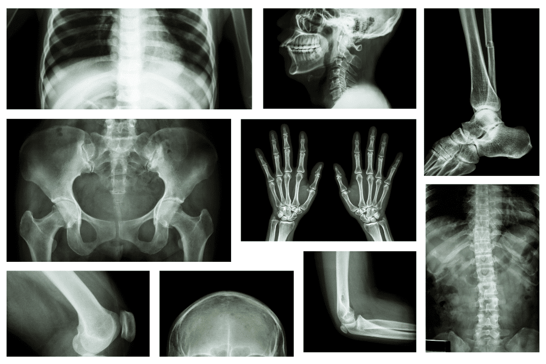 Issac bone and joint xray